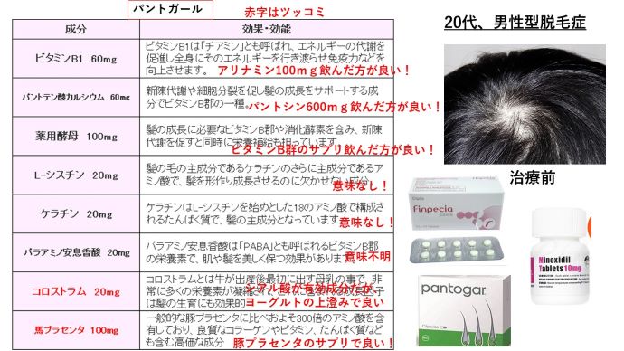 円形脱毛症　病院